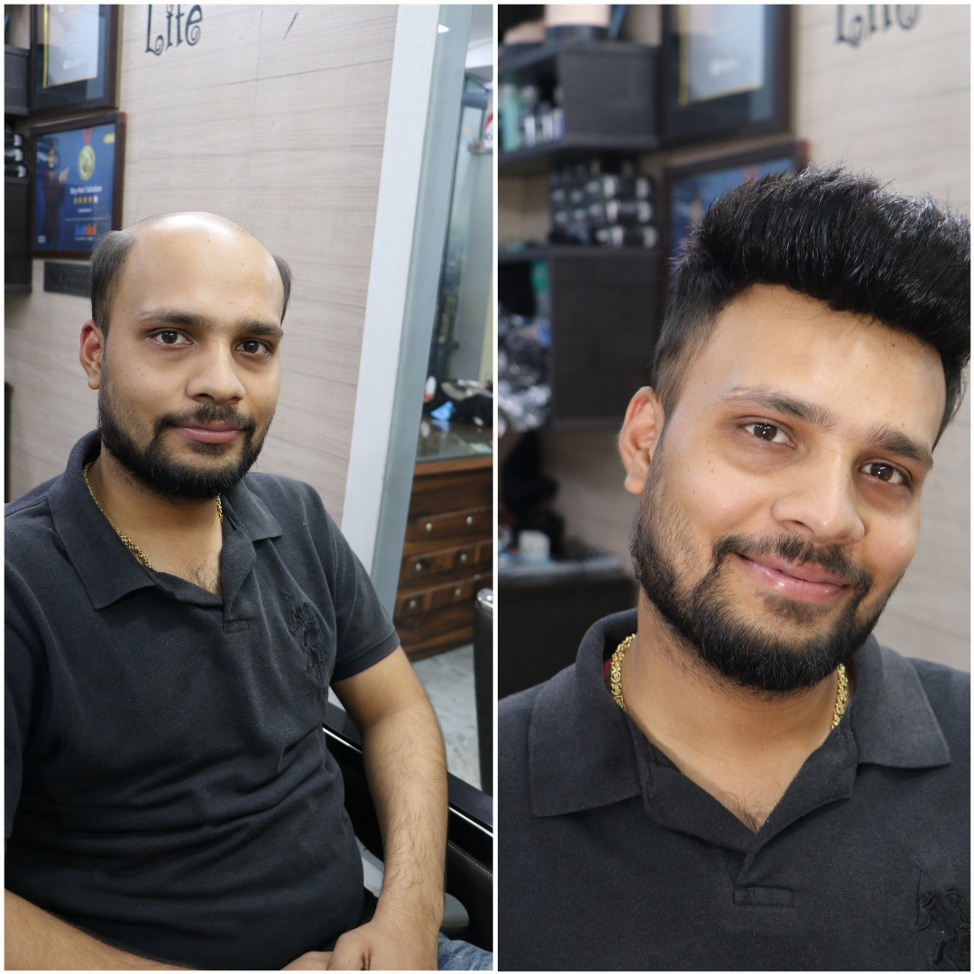 NON SURGICAL HAIR REPLACEMENT OVER HAIR TRANSPLANTS Rizy hair